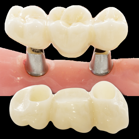 IMPLANT SỨ ZIRCONIA