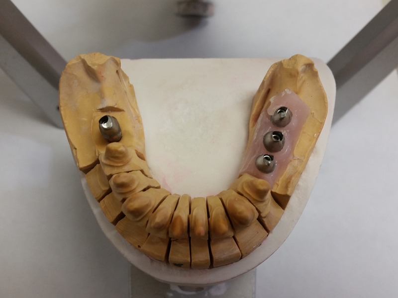 IMPLANT SỨ ZIRCONIA