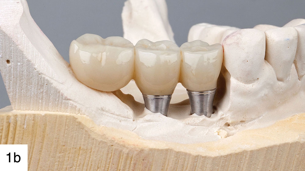 IMPLANT SỨ ZIRCONIA