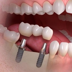 IMPLANT SỨ ZIRCONIA