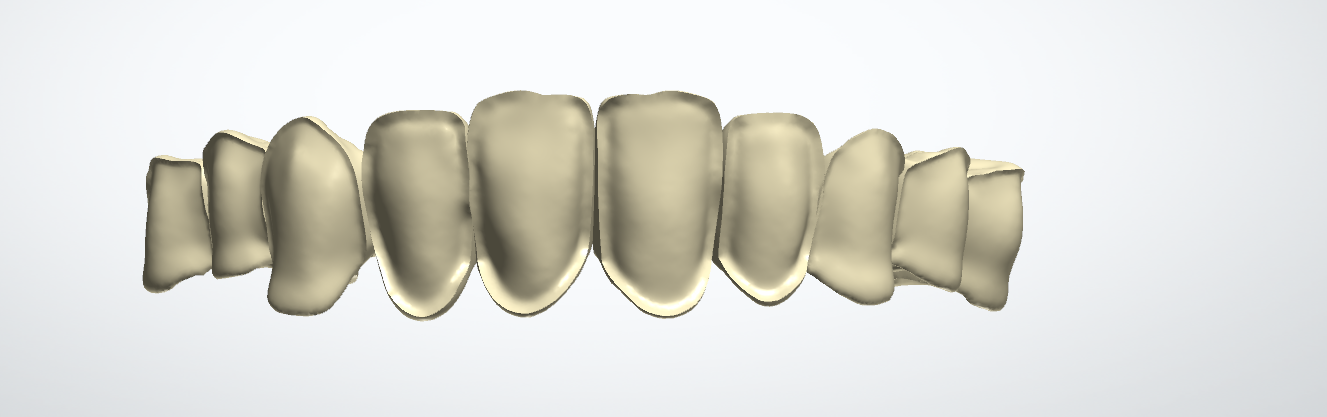 RĂNG SỨ VENEER