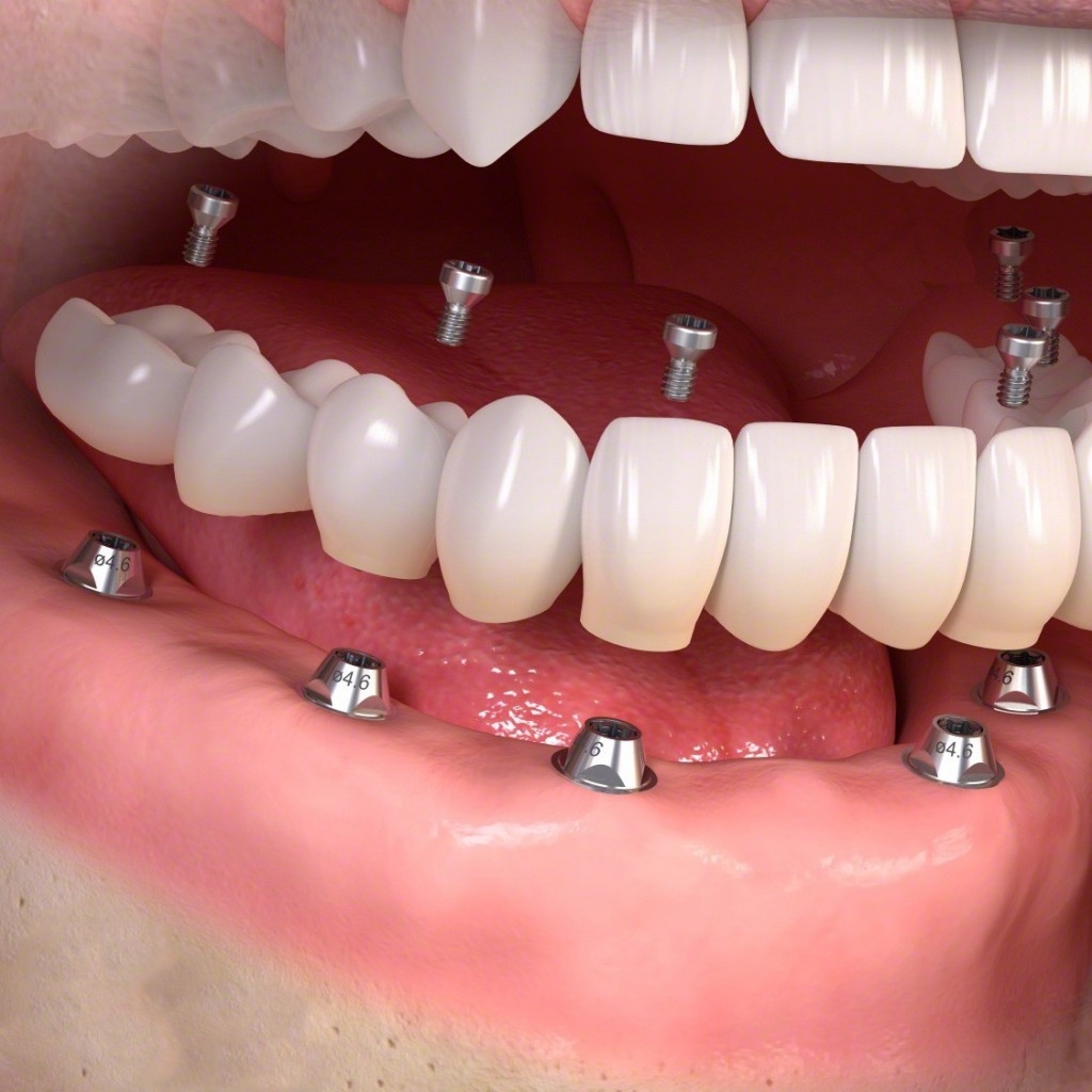 IMPLANT SỨ ZIRCONIA